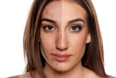 Rimedi per l'Acne