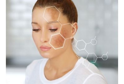MACCHIE SOLARI : PREVENZIONE E TRATTAMENTI DA IIZIARE GIA' ORA 